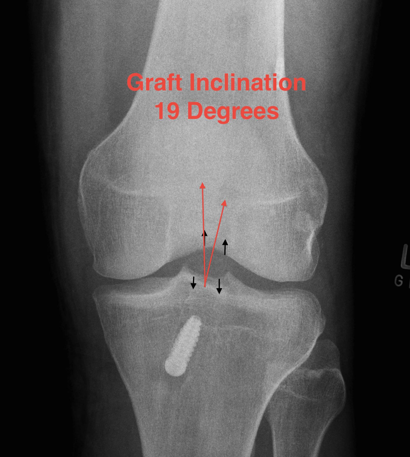ACL Reconstruction Graft Inclination Measurement